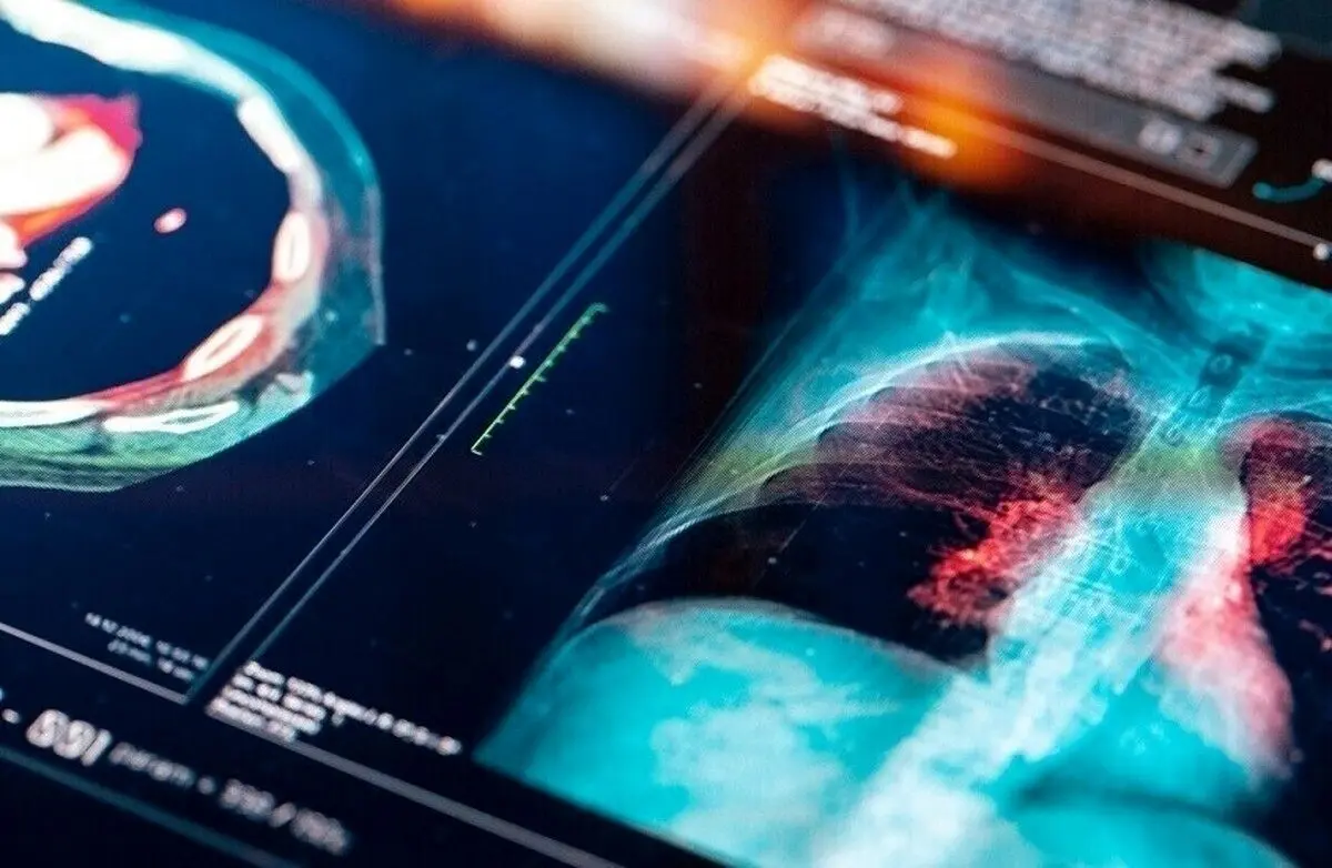 تشخیص سرطان ریه با یک آزمایش ساده روی ناخن‌ها